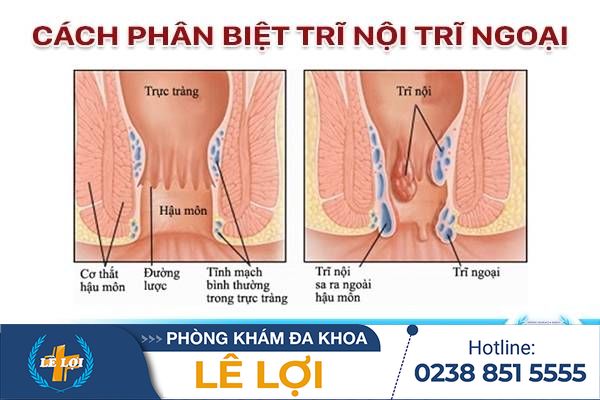 Phân biệt trĩ nội, trĩ ngoại như thế nào?